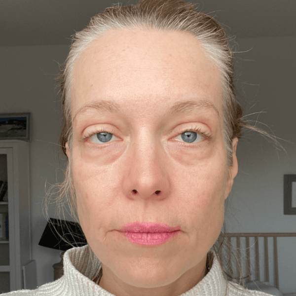 Linda nachher – Hautalterung, nach 12 Monaten