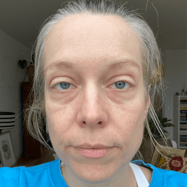 Linda vorher – Hautalterung