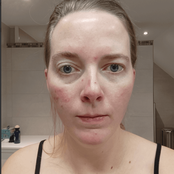 Sandra vorher – Rosacea